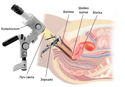 Кольпоскопия Image